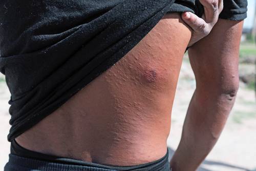 El migrante venezolano Eli Alfonso Segura muestra la herida que le provocó una bala de goma que disparó un agente de la Patrulla Fronteriza de Estados Unidos, adscrito al sector El Paso, en el bordo del río Bravo, en Ciudad Juárez.