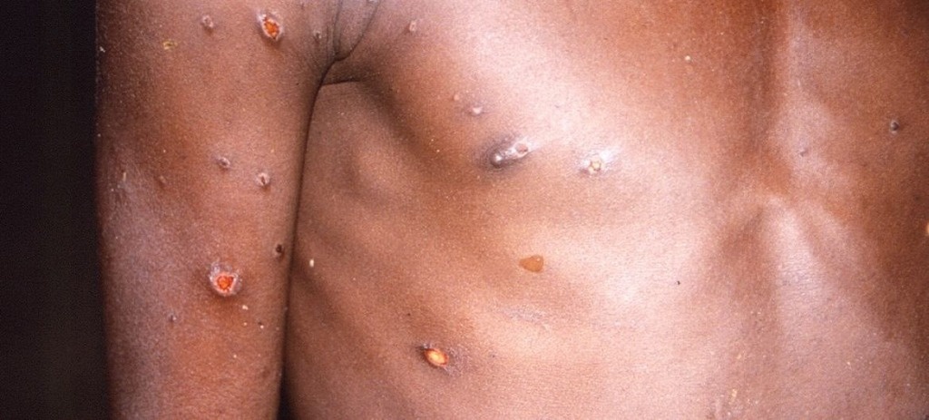 Public health emergency declared in Africa over MPOX outbreak